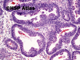 4. Rozrost gruczołowy złożony z atypią (complex endometrial hyperplasia with atypia), 10x