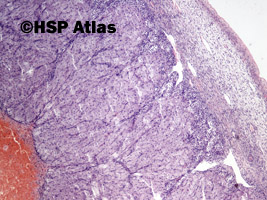 1. Torbiel krwotoczna ciałka żółtego (hemorrhagic corpus luteum), 4x