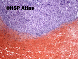 2. Torbiel krwotoczna ciałka żółtego (hemorrhagic corpus luteum), 4x
