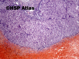 3. Torbiel krwotoczna ciałka żółtego (hemorrhagic corpus luteum), 4x