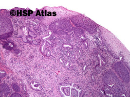 1. Śródnabłonkowa neoplazja szyjki macicy dużego stopnia (high-grade squamous intraepithelial lesion - CIN III, carcinoma in situ), 4x