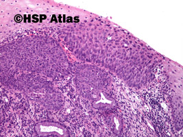 2. Śródnabłonkowa neoplazja szyjki macicy dużego stopnia (high-grade squamous intraepithelial lesion - CIN III, carcinoma in situ), 10x