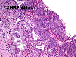 3. Śródnabłonkowa neoplazja szyjki macicy dużego stopnia (high-grade squamous intraepithelial lesion - CIN III, carcinoma in situ), 10x