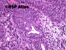 4. Śródnabłonkowa neoplazja szyjki macicy dużego stopnia (high-grade squamous intraepithelial lesion - CIN III, carcinoma in situ), 20x