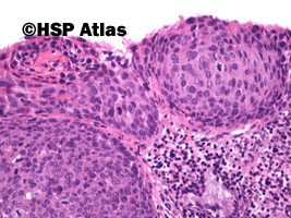 5. Śródnabłonkowa neoplazja szyjki macicy dużego stopnia (high-grade squamous intraepithelial lesion - CIN III, carcinoma in situ), 20x
