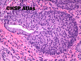 6. Śródnabłonkowa neoplazja szyjki macicy dużego stopnia (high-grade squamous intraepithelial lesion - CIN III, carcinoma in situ), 20x