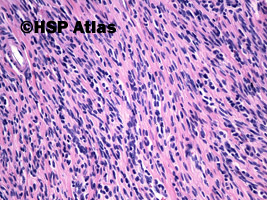 3. Mięśniak gładkokomórkowy jajnika (leiomyoma cellulare), guz jajnika, 58 lat, 20x