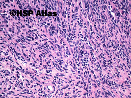 4. Mięśniak gładkokomórkowy jajnika (leiomyoma cellulare), guz jajnika, 58 lat, 20x