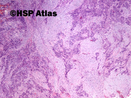 1. Mieszany złośliwy guz z przewodów Mullera (malignant mixed Mullerian tumor - MMMT), 4x