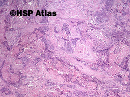 2. Mieszany złośliwy guz z przewodów Mullera (malignant mixed Mullerian tumor - MMMT), 4x