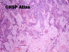 3. Mieszany złośliwy guz z przewodów Mullera (malignant mixed Mullerian tumor - MMMT), 4x