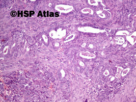 6. Mieszany złośliwy guz z przewodów Mullera (malignant mixed Mullerian tumor - MMMT), 10x