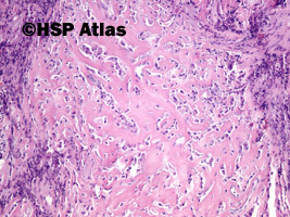 7. Mieszany złośliwy guz z przewodów Mullera (malignant mixed Mullerian tumor - MMMT), 10x