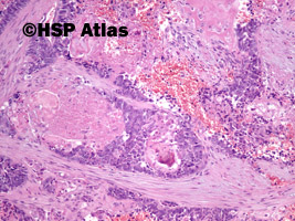 8. Mieszany złośliwy guz z przewodów Mullera (malignant mixed Mullerian tumor - MMMT), 10x