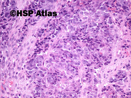 9. Mieszany złośliwy guz z przewodów Mullera (malignant mixed Mullerian tumor - MMMT), 20x