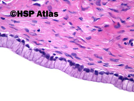 5. Torbielakogruczolak śluzowy (mucinous cystadenoma), 40x