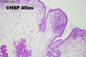 3. Potworniak dojrzały torbielowaty (mature cystic teratoma), 4x
