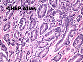 4. Rak gruczołowy, Gleason 3+3 (adenocarcinoma, Gleason score 3+3), 20x