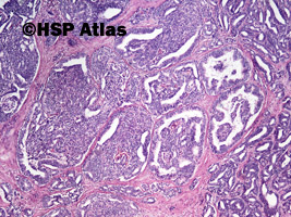 2. Rak gruczołowy, Gleason 4+4 (adenocarcinoma, Gleason score 4+4), 4x