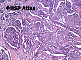 4. Rak gruczołowy, Gleason 4+4 (adenocarcinoma, Gleason score 4+4), 4x