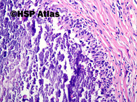 4. Idiopatyczna kalcynoza moszny (idiopathic scrotal calcinosis), 20x
