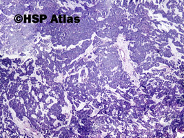 1. Gruczolakorak śluzowy - rak koloidowy (mucinous (colloid) adenocarcinoma), 4x