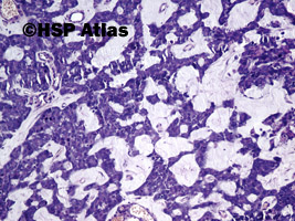 2. Gruczolakorak śluzowy - rak koloidowy (mucinous (colloid) adenocarcinoma), 10x