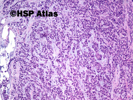 3. Gruczolakorak śluzowy - rak koloidowy (mucinous (colloid) adenocarcinoma), 10x