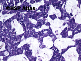 4. Gruczolakorak śluzowy - rak koloidowy (mucinous (colloid) adenocarcinoma), 20x