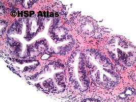 1. Śródnabłonkowa neoplazja stercza, dużego stopnia (HGPIN, high-grade prostate intraepithelial neoplasia), 10x