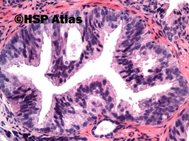 2. HGPIN, high-grade prostate intraepithelial neoplasia, 20x