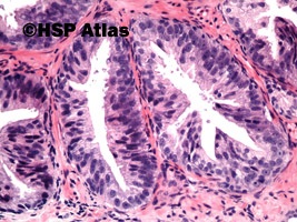 3. Śródnabłonkowa neoplazja stercza, dużego stopnia (HGPIN, high-grade prostate intraepithelial neoplasia), 20x