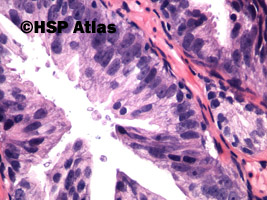 4. Śródnabłonkowa neoplazja stercza, dużego stopnia (HGPIN, high-grade prostate intraepithelial neoplasia), 40x