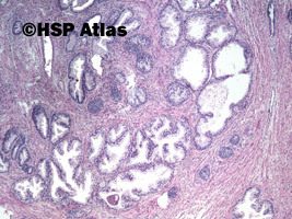 3. Rozrost guzkowy prostaty (nodular prostatic hyperplasia), 4x