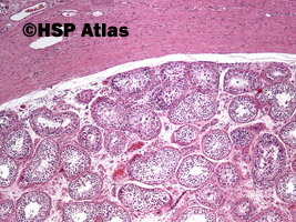 1. Wewnątrzprzewodowa neoplazja komórek zarodkowych (intratubular germ cell neoplasia - IGCN), 4x