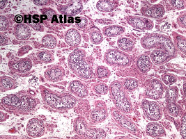 2. Wewnątrzprzewodowa neoplazja komórek zarodkowych (intratubular germ cell neoplasia - IGCN), 4x