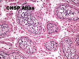 3. Wewnątrzprzewodowa neoplazja komórek zarodkowych (intratubular germ cell neoplasia - IGCN), 10x