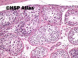 4. Wewnątrzprzewodowa neoplazja komórek zarodkowych (intratubular germ cell neoplasia - IGCN), 10x