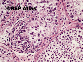 5. Wewnątrzprzewodowa neoplazja komórek zarodkowych (intratubular germ cell neoplasia - IGCN), 20x