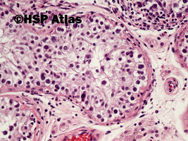 6. Wewnątrzprzewodowa neoplazja komórek zarodkowych (intratubular germ cell neoplasia - IGCN), 20x