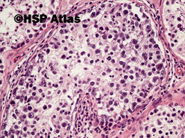 7. Wewnątrzprzewodowa neoplazja komórek zarodkowych (intratubular germ cell neoplasia - IGCN), 20x