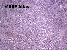 2. Guz z komórek Leydiga (Leydig cell tumor), 4x