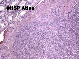 3. Guz z komórek Leydiga (Leydig cell tumor), 4x