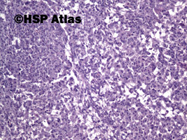 4. Guz z komórek Leydiga (Leydig cell tumor), 10x