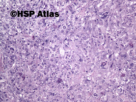 5. Guz z komórek Leydiga (Leydig cell tumor), 10x