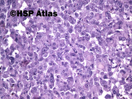 6. Guz z komórek Leydiga (Leydig cell tumor), 20x