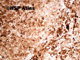 9. Inhibin, Leydig cell tumor, 10x