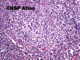 1. Mixed germ cell tumor - embryonal carcinoma, 10x
