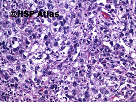 2. Mixed germ cell tumor - embryonal carcinoma, 20x