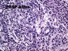 3. Mixed germ cell tumor - embryonal carcinoma, 20x